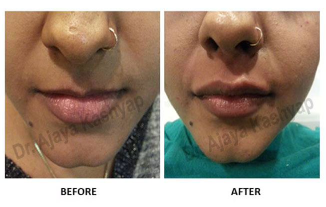 lip augmentation in india